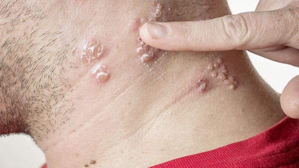 猴痘蔓延全球21国 国内尚无病例 世卫组织表示猴痘或有特效药