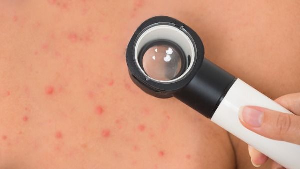 猴痘蔓延全球21国 国内尚无病例 世卫组织表示猴痘或有特效药