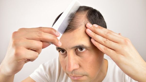 全球首款用于治疗严重斑秃的抑制剂有望上市 这些药企紧盯你的头发