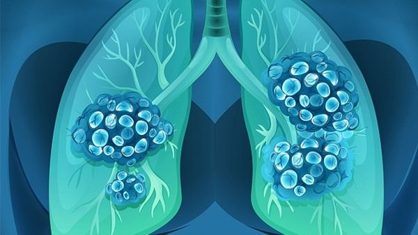 中国科学家重新定义“肺癌治愈” 研究团队公布肺癌MRD重要研究成果
