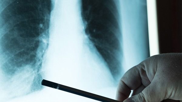 中国科学家重新定义“肺癌治愈” 研究团队公布肺癌MRD重要研究成果