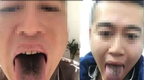 男子确诊后舌头牙齿全变黑，网友调侃“黑株”是真的吗？
