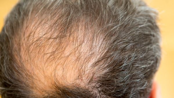 国内百万人或将摆脱秃顶困境，治疗重度斑秃创新靶向药获批