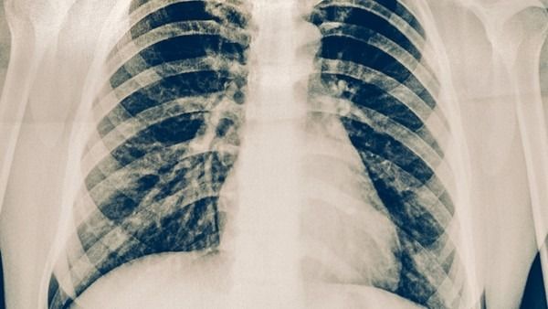 呼吸科专家辟谣：10个呼吸道感染谣言别轻信