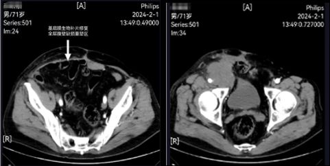 图 1：术前会诊 CT 显示明显的类腹壁腱膜组织
