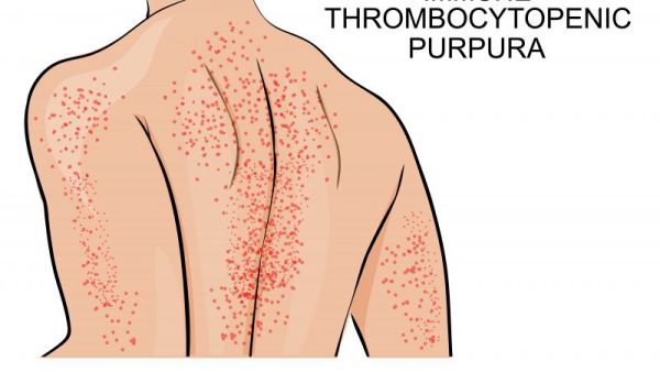 单纯性紫癜的症状