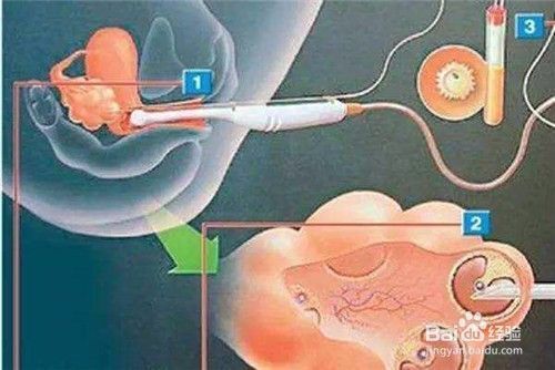 试管婴儿是怎么做的 试管婴儿的具体流程