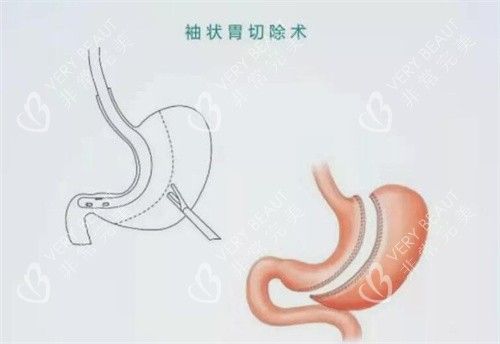 袖状胃切除手术卡通示意图