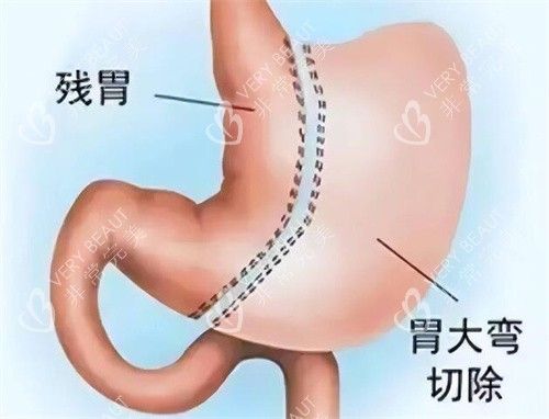 袖状胃切除手术改善展示图