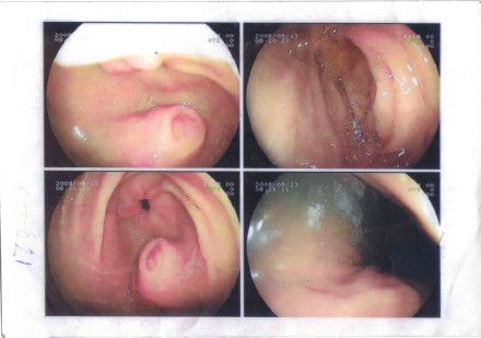 003 网友小婉的病情分析===GIST  or  Heterotopic Pancr