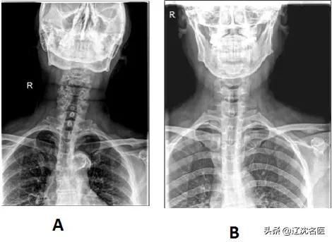 眩晕千万种，辨证施治很重要