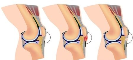 四个腰腹吸脂案例
