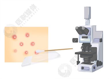 皮肤涂片检查