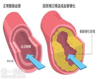 胆固醇高怎样治疗 降低“胆固醇”有方法