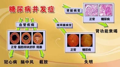 得糖尿病之前会有那些征兆有图篇