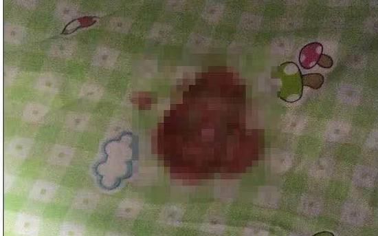 寶寶床單上的血跡。受訪者供圖