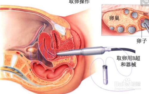 供卵试管婴儿详细操作流程