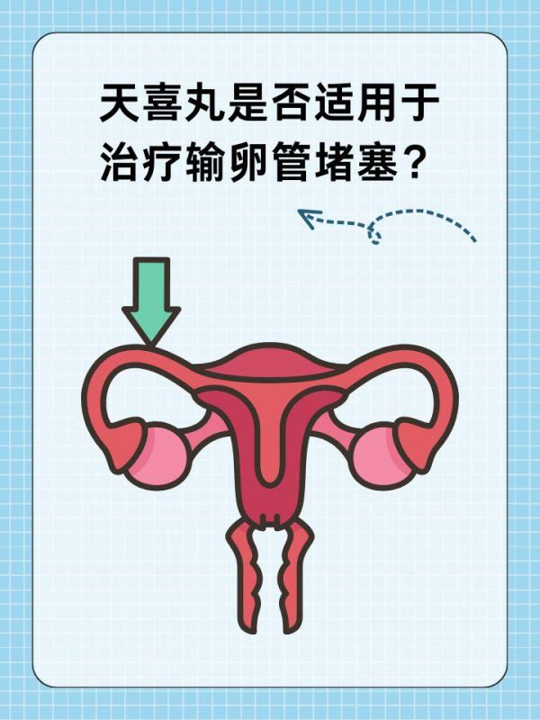 天喜丸是否適用于治療輸卵管堵塞？