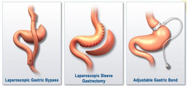 bariatric-surgery-in-chennai.jpg