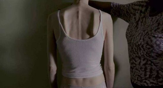 2017年上映的美國電影《骨瘦如柴》，講述了患有厭食癥的女子在醫(yī)生激勵下，直視疾病與其斗爭的故事。電影的導(dǎo)演馬蒂·諾克森曾一度厭食到心臟驟停，女主角莉莉·柯林斯也曾患有厭食癥。電影劇照