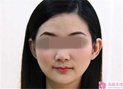 面部線雕有何美容效果