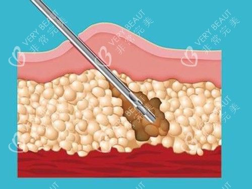 吸脂针图片