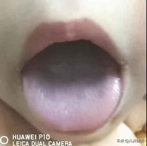 许尤佳教授：小儿积食调理指南（含方法和案例）