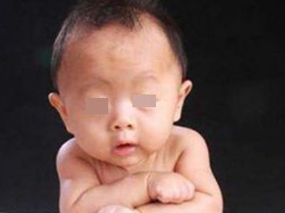 營養(yǎng)不良性消瘦身體消瘦像老人圖.jpg