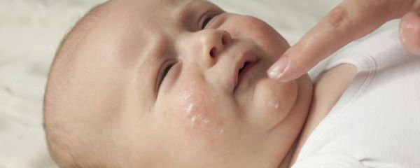宝宝湿疹的原因 如何预防宝宝湿疹 宝宝湿疹