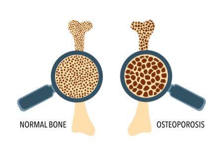 normal bone and osteoporosis bone