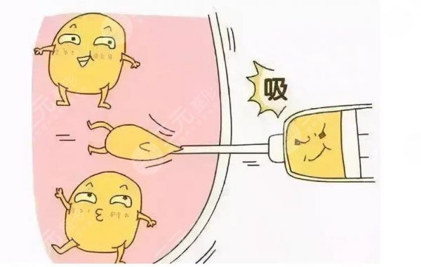 吸脂减肥会反弹吗?