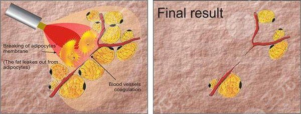 吸脂减肥会反弹吗?