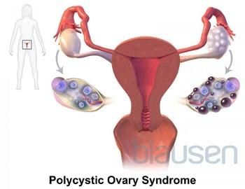 多囊卵巢综合征 (PCOS)