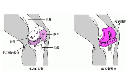 cartistem膝关节手术在韩国用于运动创伤治疗,注射在关节部位