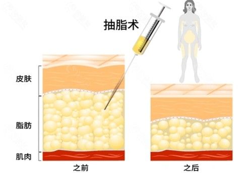 杭州吸脂好的医生和价格