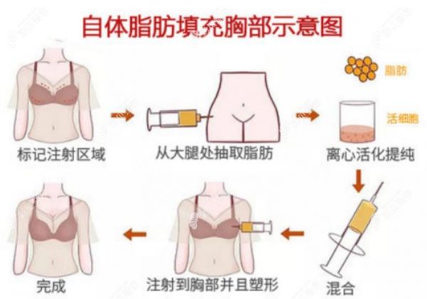 自体脂肪丰胸过程图解
