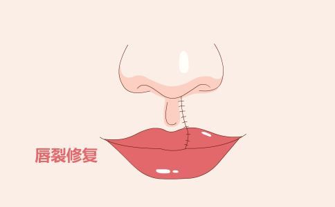 背部吸脂多少錢(qián) 背部吸脂價(jià)格是多少 背部吸脂的步驟是什么