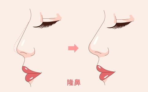 背部吸脂多少錢(qián) 背部吸脂價(jià)格是多少 背部吸脂的步驟是什么