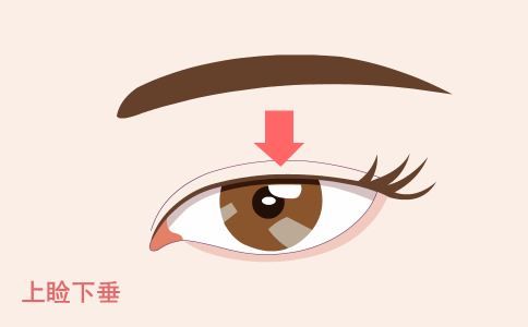 背部吸脂效果怎么樣 背部吸脂效果如何 背部吸脂有什么好處