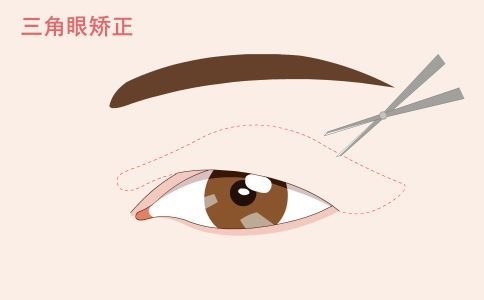 背部吸脂效果怎么樣 背部吸脂效果如何 背部吸脂有什么好處