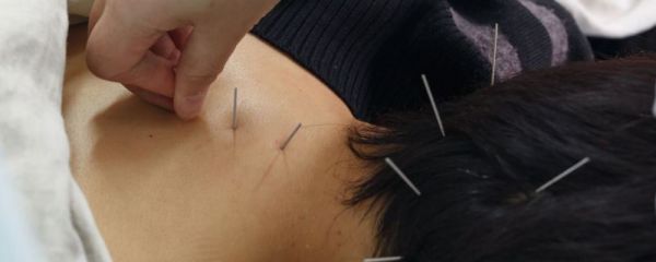 中醫(yī)針灸的療效 中醫(yī)針灸的原理 中醫(yī)針灸
