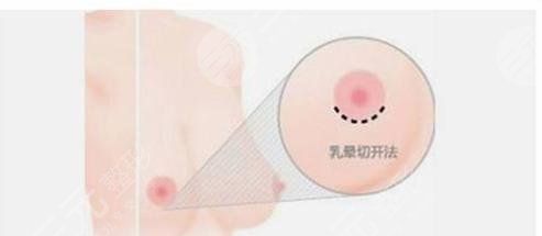 隆胸