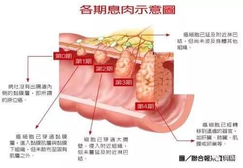 新电疗灭直肠癌快准狠！无需手术，适合老年患者