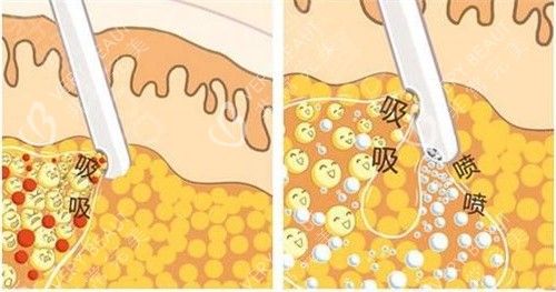 抽脂手术抽脂方式动画演示图