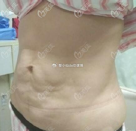 生完孩子三年了皮肤还很松弛