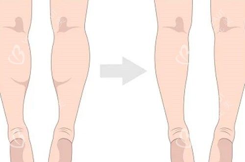 吸脂瘦小腿