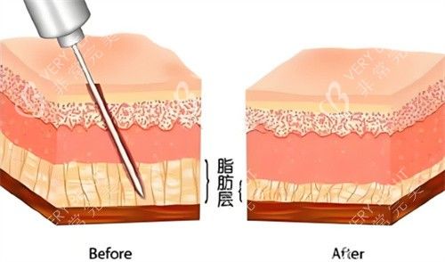 吸脂手術脂肪層對比