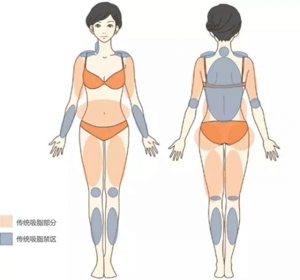吸脂部位.jpg