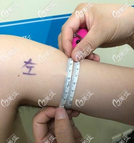 手臂吸脂很多人没细的原因揭秘