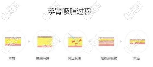 手臂吸脂过程图解